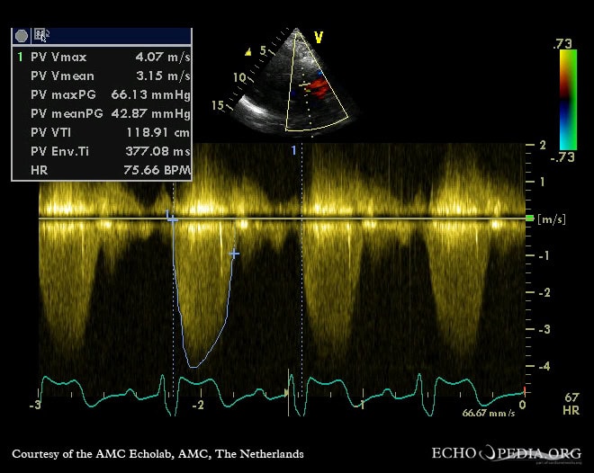 CW-Doppler-Ultraschallbild einer Pulmonalklappenstenose.