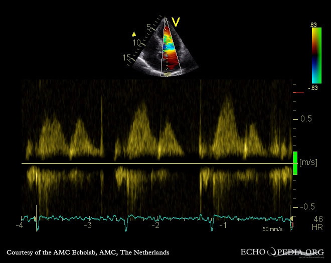 PW-Doppler-Ultraschallbild der Vena cava inferior (untere Hohlvene) PW-Doppler-Ultraschallbild der Vena cava inferior (untere Hohlvene)