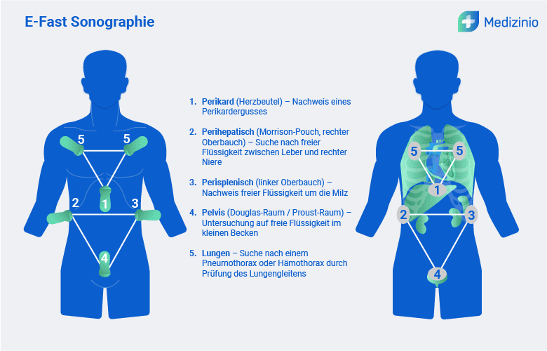 Schematische Darstellung der E-Fast Sonographie mit markierten Untersuchungsbereichen zur Detektion freier Flüssigkeit im Körper.