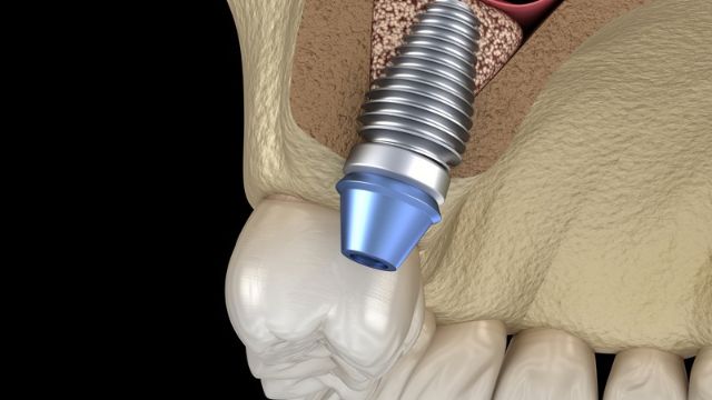 3D-Implantatplanung eines Zahnimplantats im Oberkiefer mit Sinuslift und Knochenaufbau.