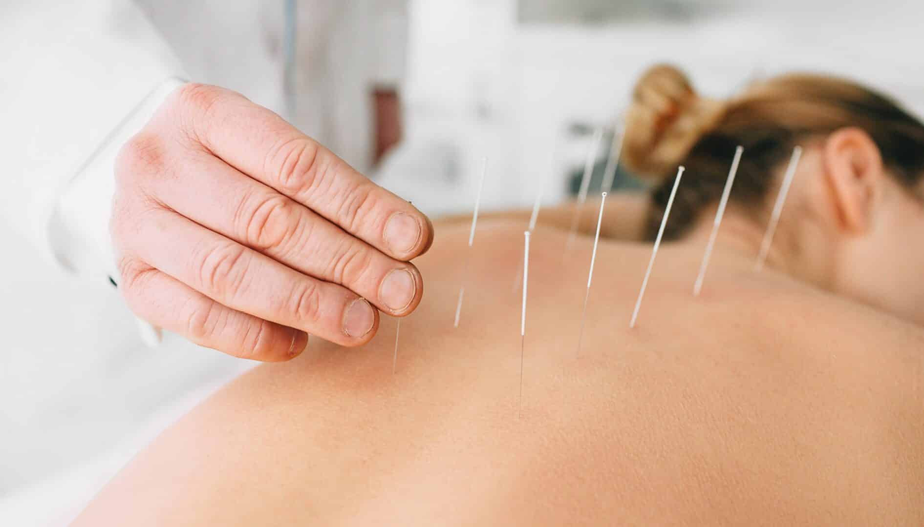 medical acupuncture