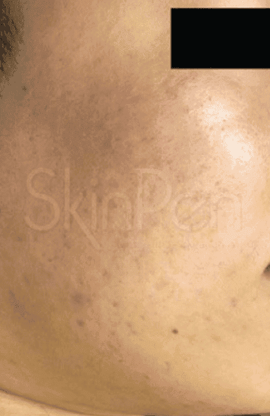 skinpen after1