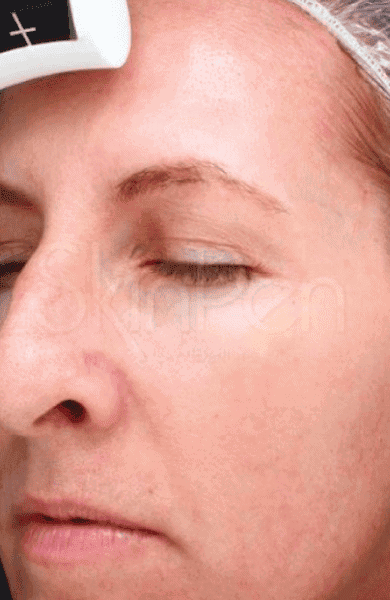 skinpen after2