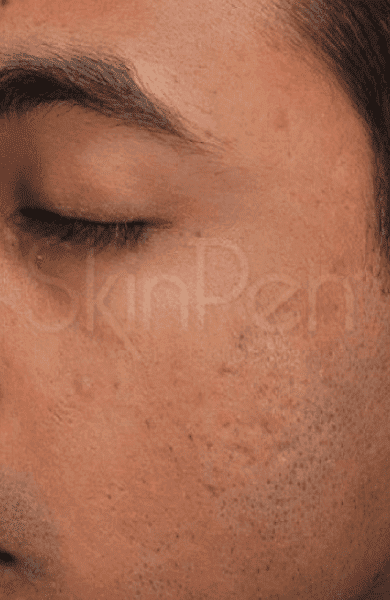 skinpen after3