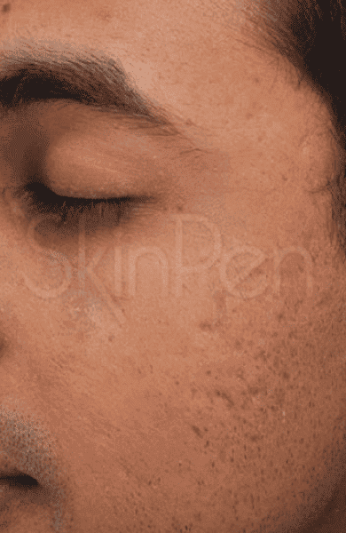 skinpen before3