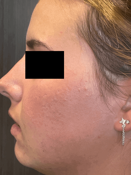 as skinpen after left cheek bo