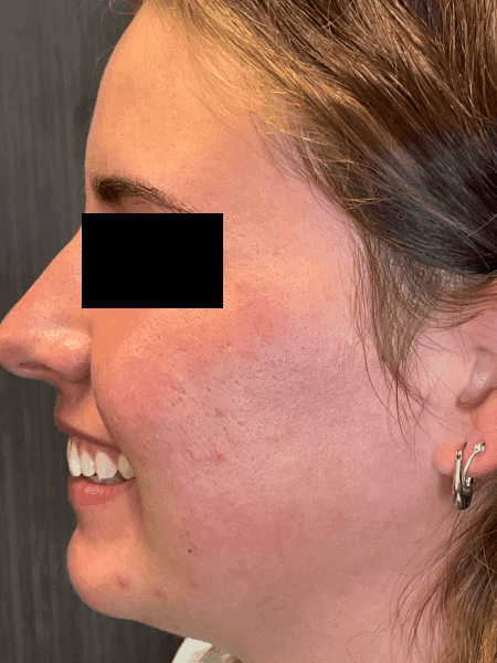as skinpen before left cheek bo