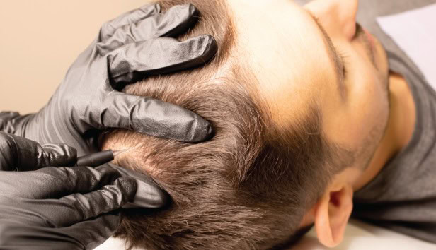 hair restoration2