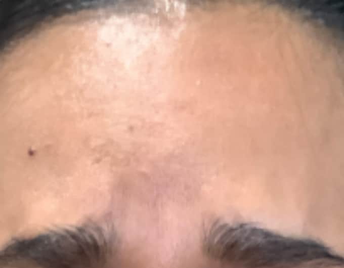 botox after 1