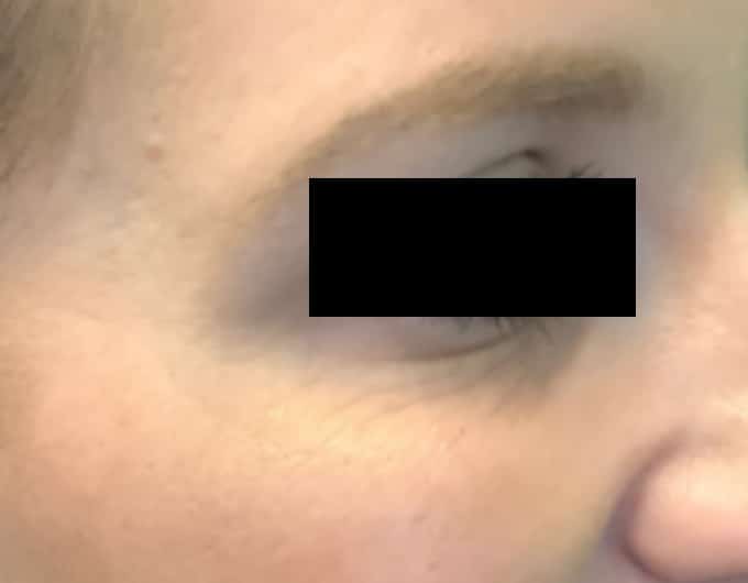 botox after 3