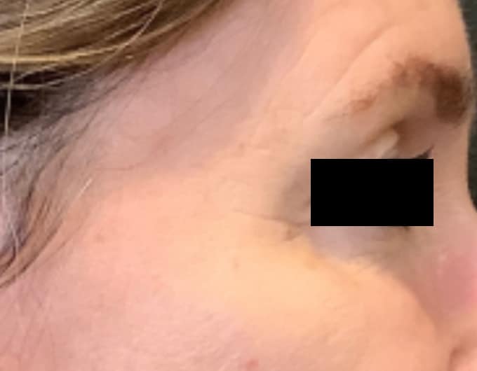 botox after 4