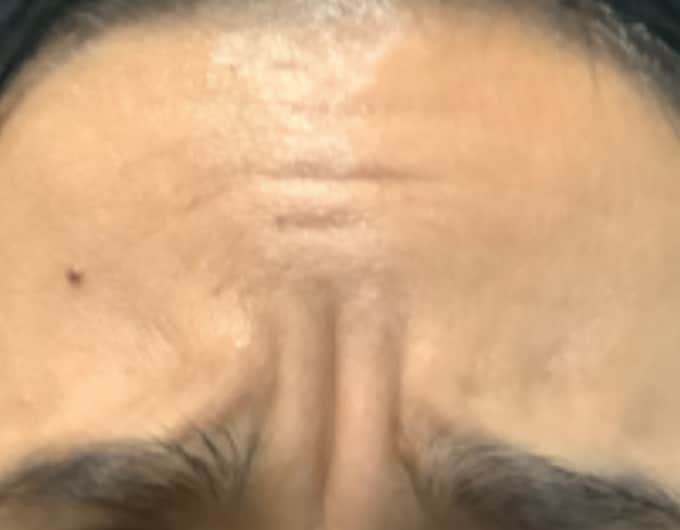 botox before 1