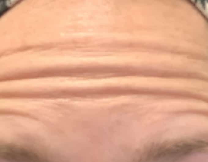 botox before 2
