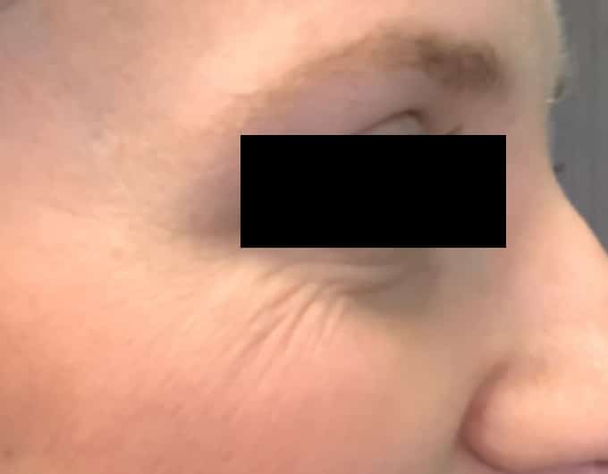 botox before 3
