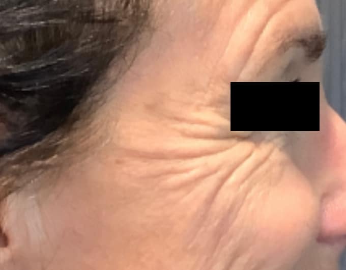 botox before 4