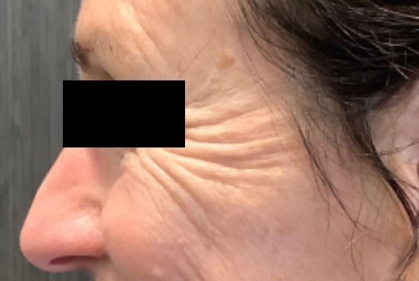 botox before 6