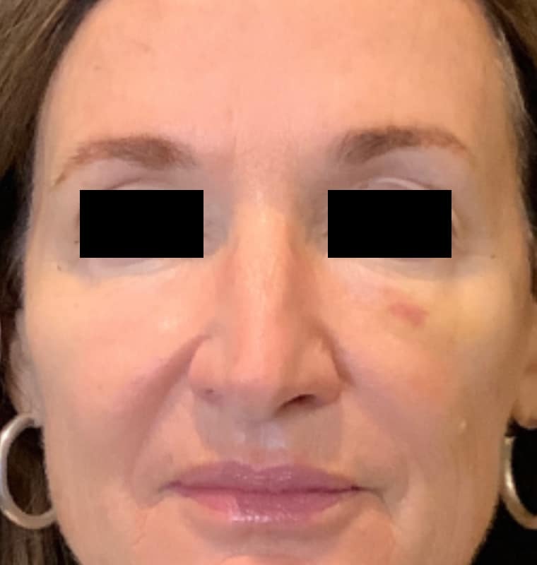 cheek filler after 1