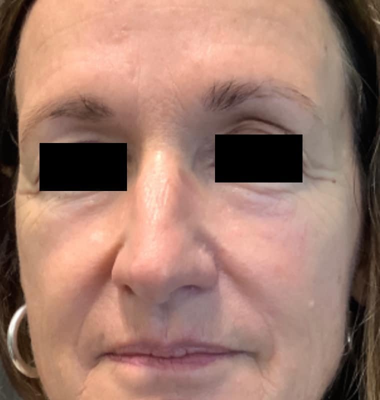 cheek filler before 1