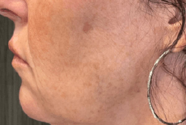 derma filler after 1