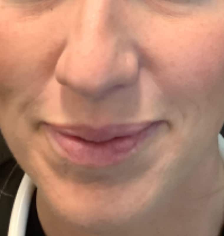 derma filler after 11