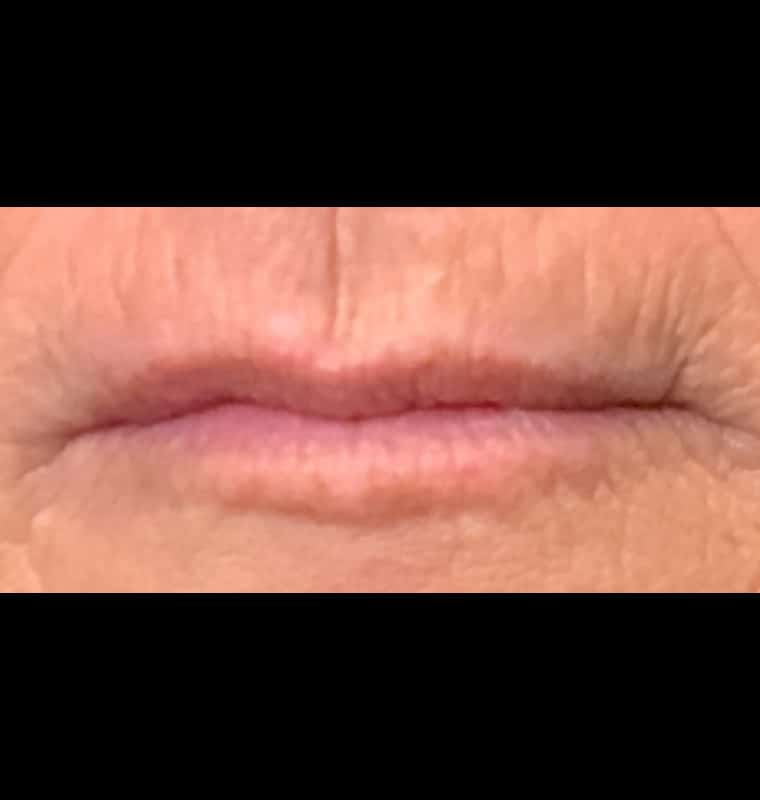 derma filler after 12