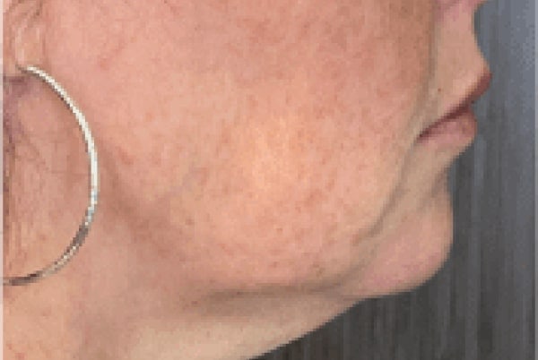 derma filler after 2
