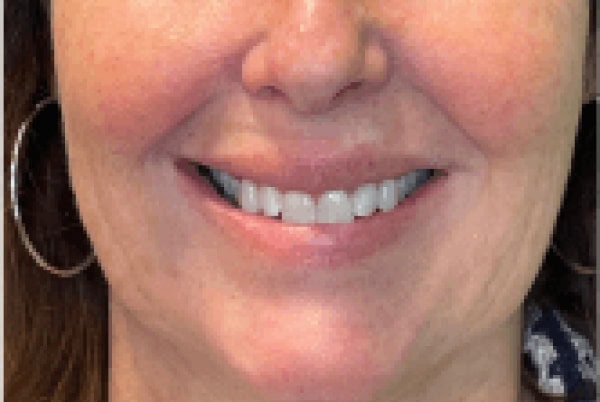derma filler after 3