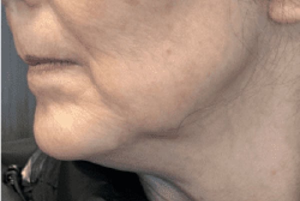 derma filler after 4