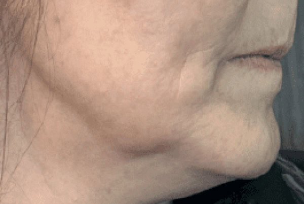 derma filler after 5