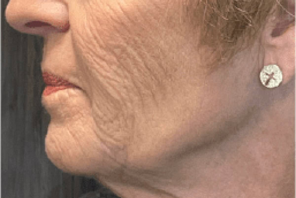 derma filler after 6