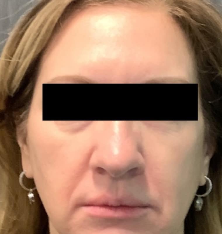 derma filler after 7