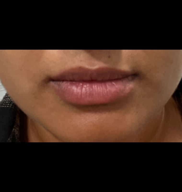 derma filler after 9