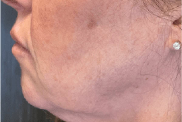 derma filler before 1