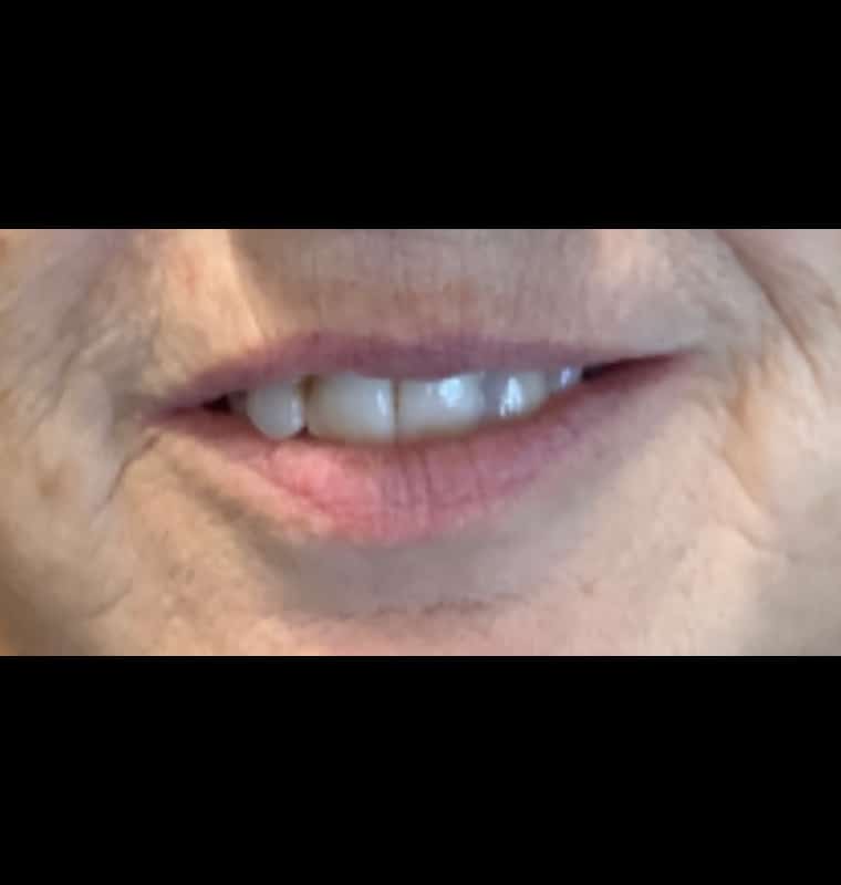 derma filler before 10