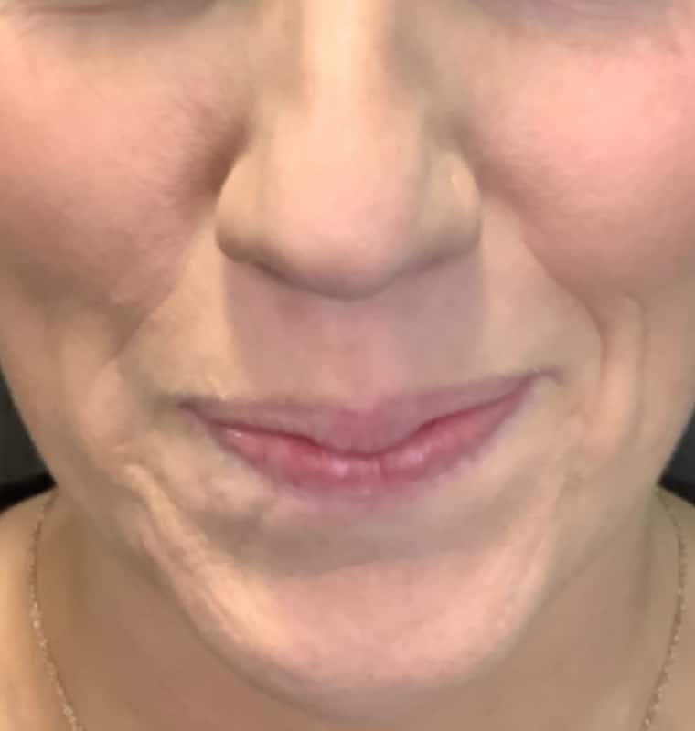 derma filler before 11