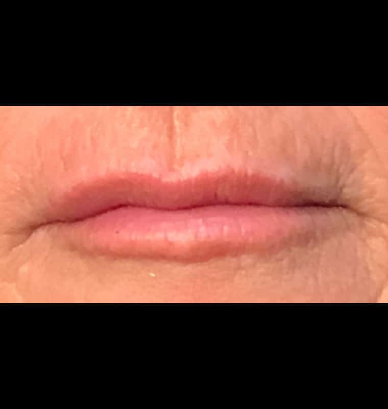 derma filler before 12