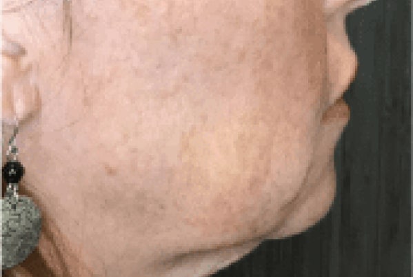 derma filler before 2