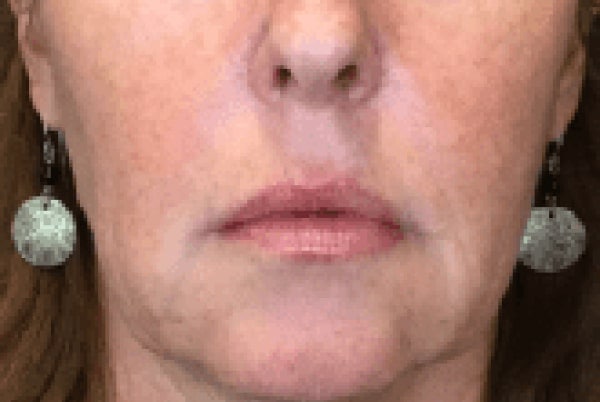 derma filler before 3