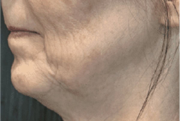 derma filler before 4