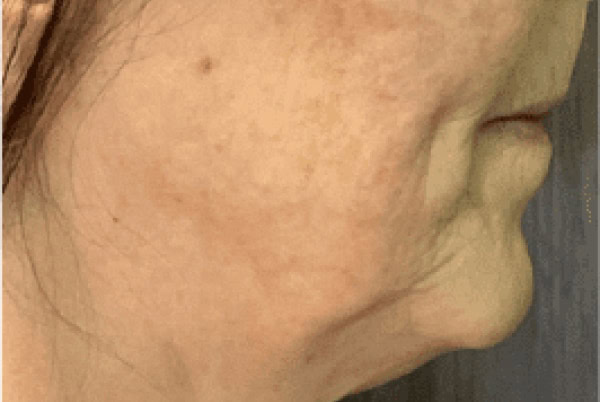 derma filler before 5