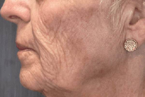 derma filler before 6