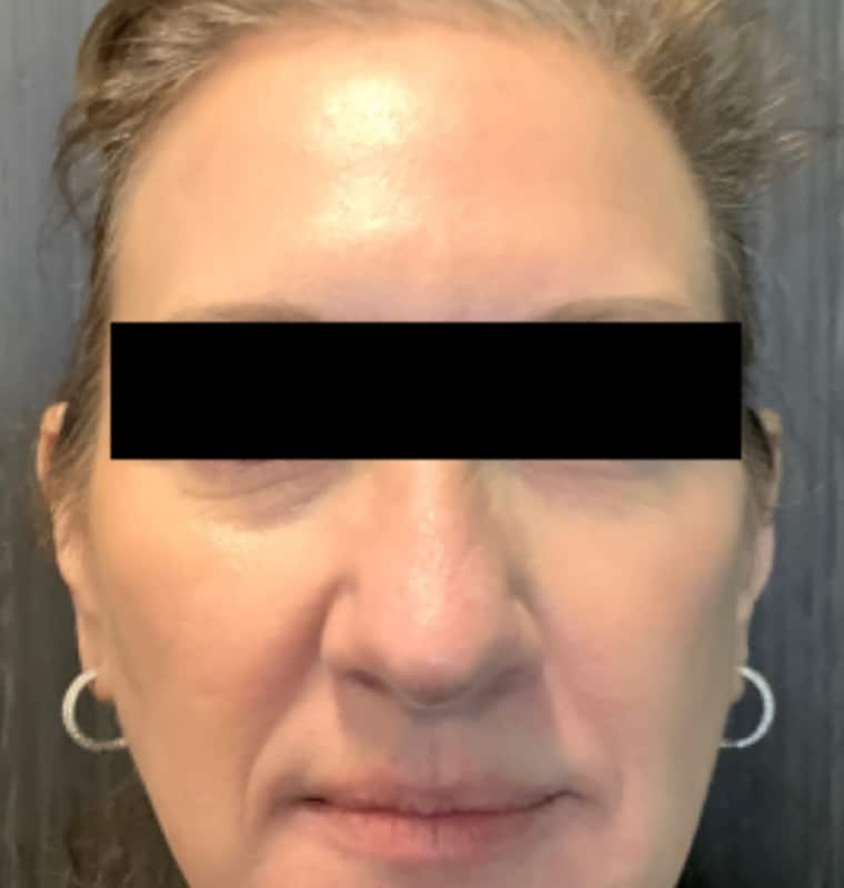 derma filler before 7