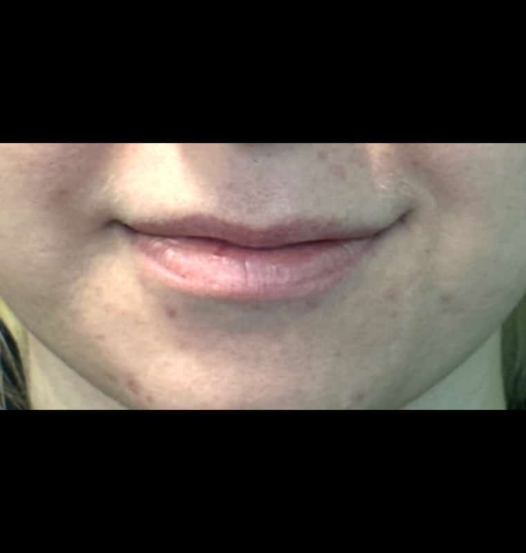 derma filler before 8