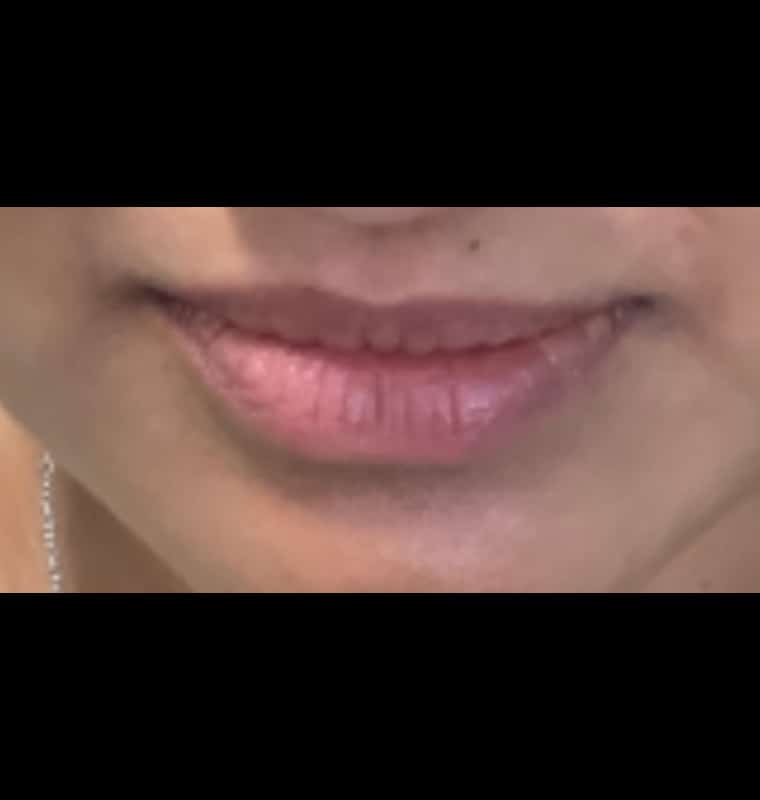 derma filler before 9