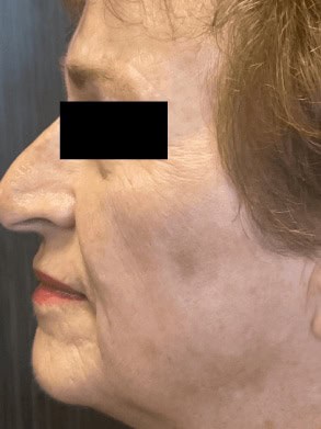 laser therapy after 1