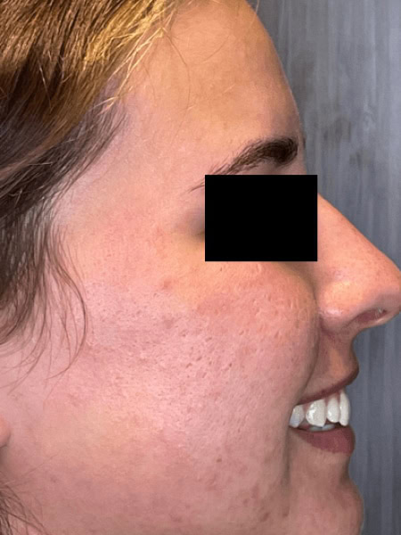 microneedling before 1