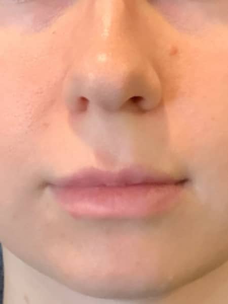 skinpen after 1
