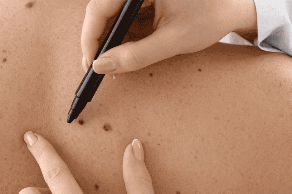image skin cancer