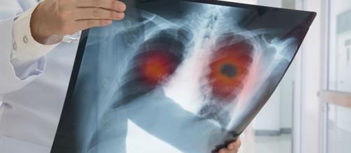 radiografie coronavirus