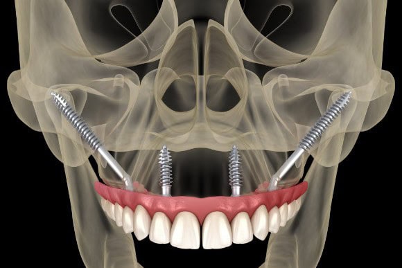 Grafische Darstellung Zygoma-Implantate